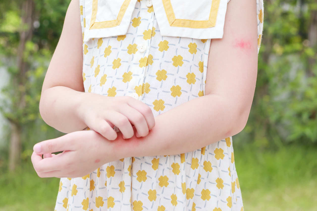Prevenindo Alergias em Crianças: O que os Pais Precisam Saber